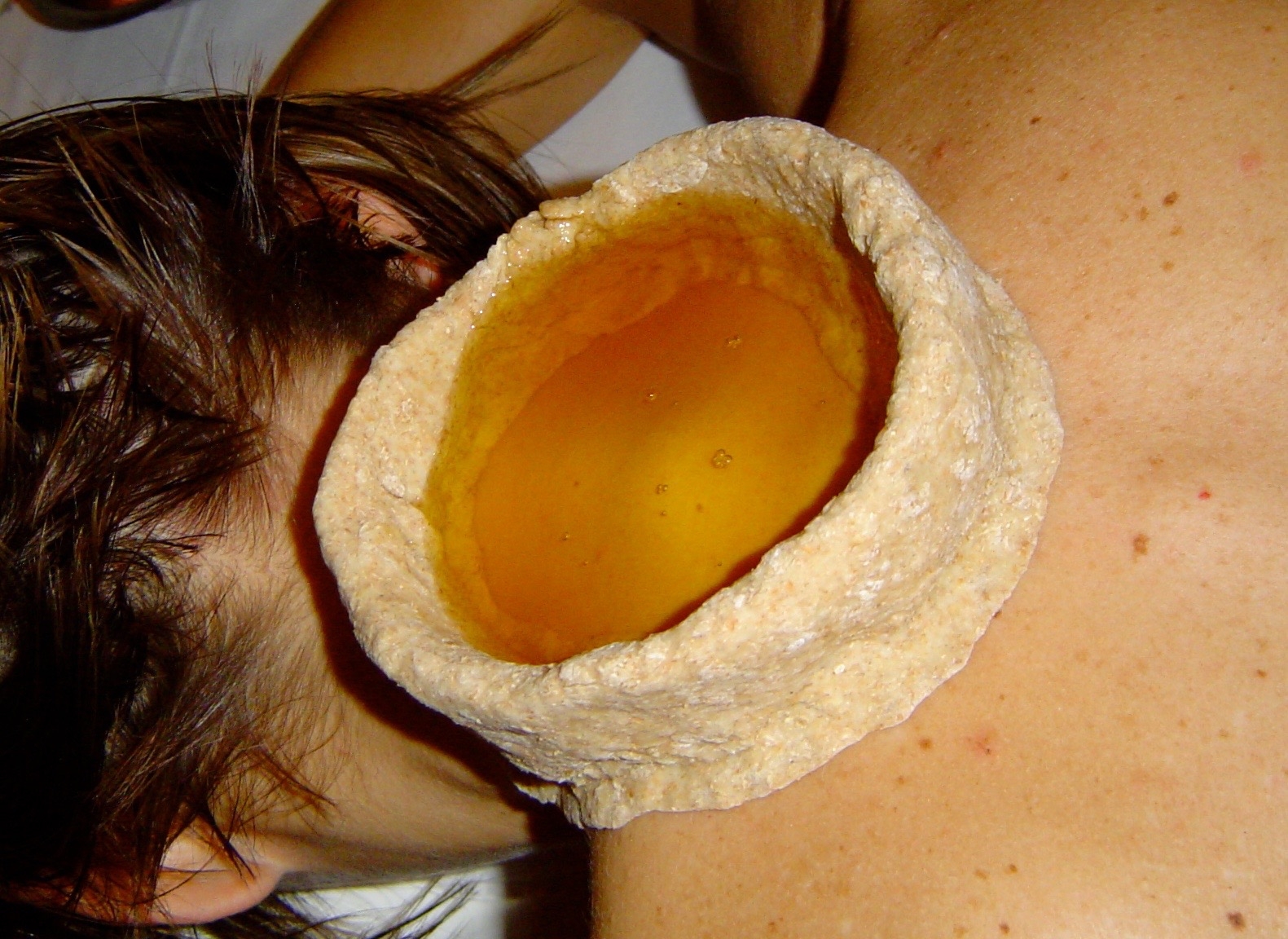 Trattamento Griva Vasti (mantenimento di olio caldo sul collo) | Ayurvedic Point©, Milano